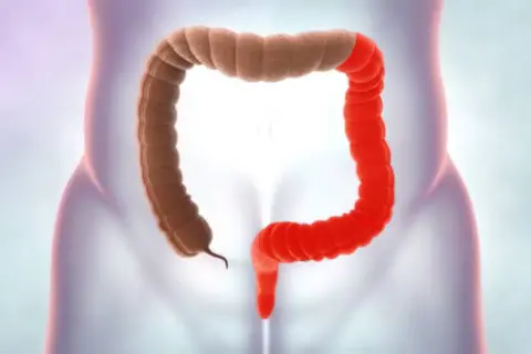 colitis_izquierda