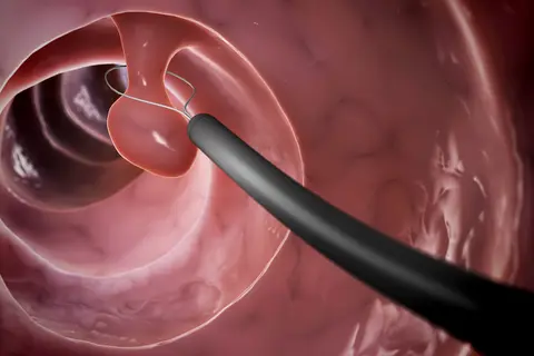 polyp_removal