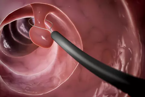 polyp_removal