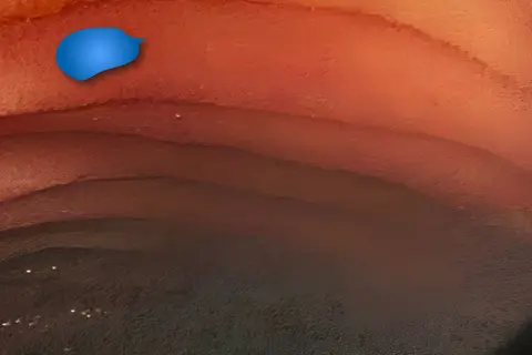 colontorectum_02.jpg