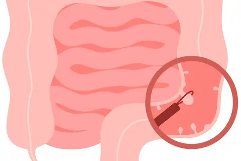 ilustracion_colonoscopia_intestinal