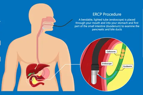 endoscopic-retrograde-cholangiopancreatography.jpg
