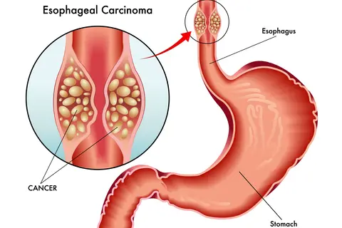 esophageal-carcinoma.jpg