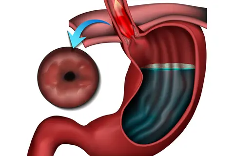 barretts_esophagus