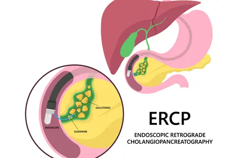 ercp