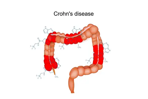 crohns_disease
