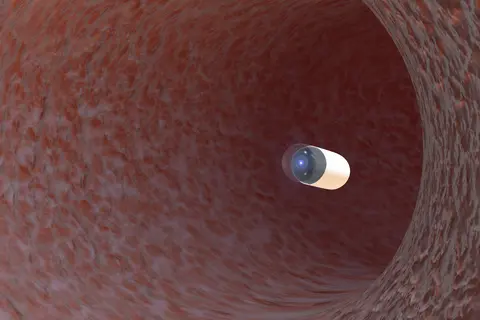 endoscopía_cápsula_de_Bowel