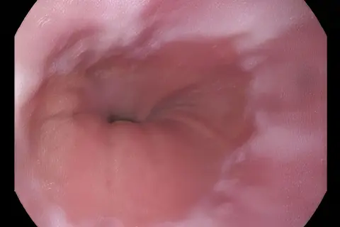 esófago_endoscopía