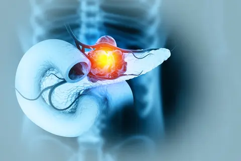 pancreatic-cancer