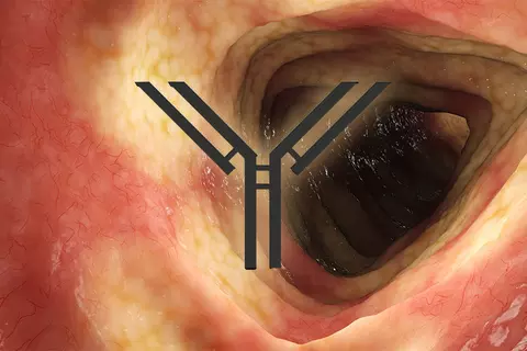 crohn-s-disease-