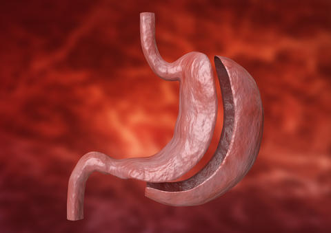 gastrectomy-bariatric
