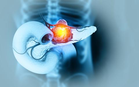 pancreatic-cancer