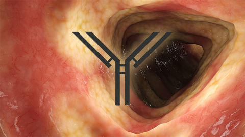 crohn-s-disease-