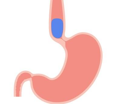 achalasia