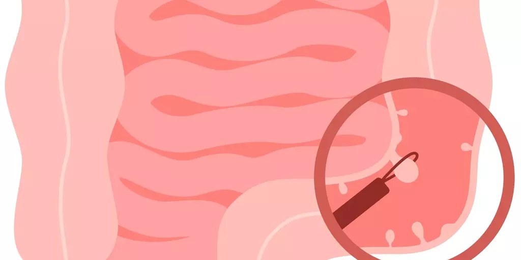 ilustracion_colonoscopia_intestinal