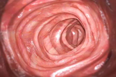 colonoscopía1