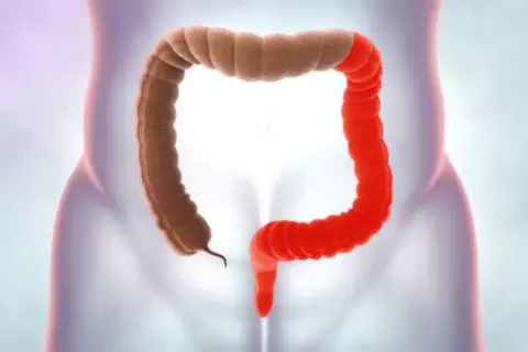 colitis_izquierda