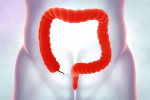 pancolitis