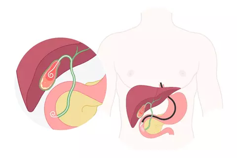endoscopic_transpapillary_gallbladder