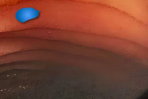 colontorectum_02.jpg