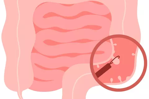ilustracion_colonoscopia_intestinal
