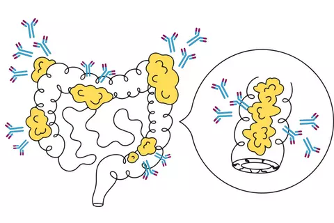 chronic-inflammatory-bowel-disease.jpg