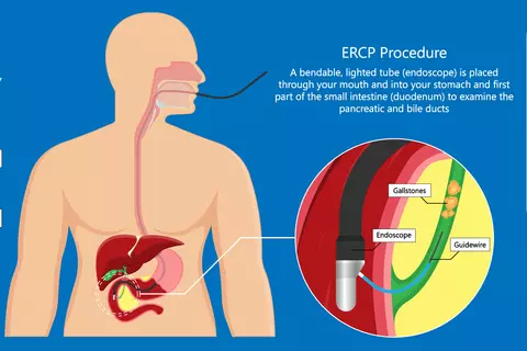 endoscopic-retrograde-cholangiopancreatography.jpg