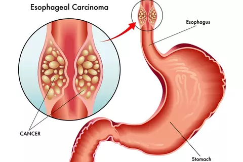 esophageal-carcinoma.jpg