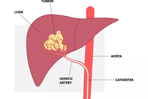 vector-transarterial-chemoembolization.jpg