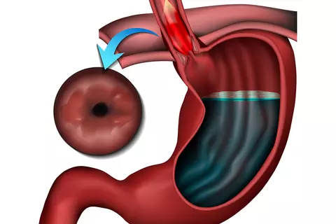 barretts_esophagus