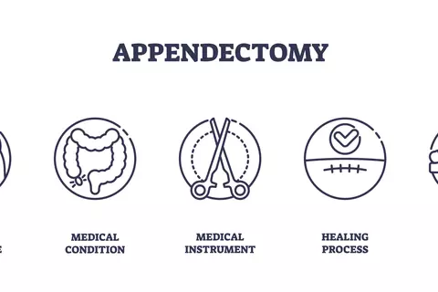 Appendectomy