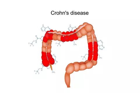 crohns_disease