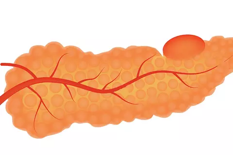 pancreatic_cancer