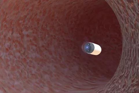 endoscopía_cápsula_de_Bowel