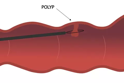 colon-polyp