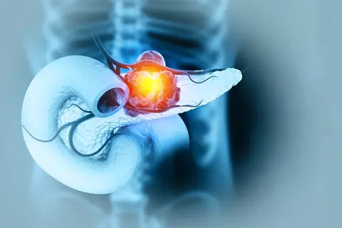pancreatic-cancer