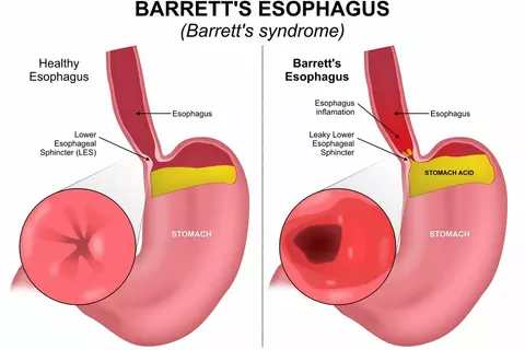 barretts-esophagus