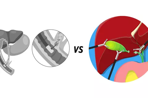 cholecystectomy_and_ERCP