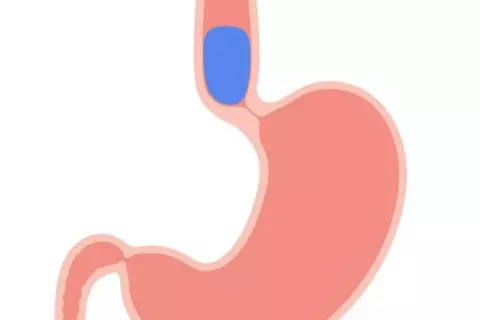 achalasia