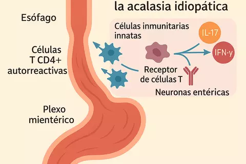 acalasia_idiopatica_ia_1