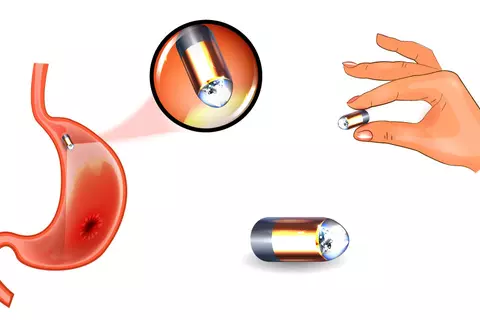 bowel_capsule_endoscopy