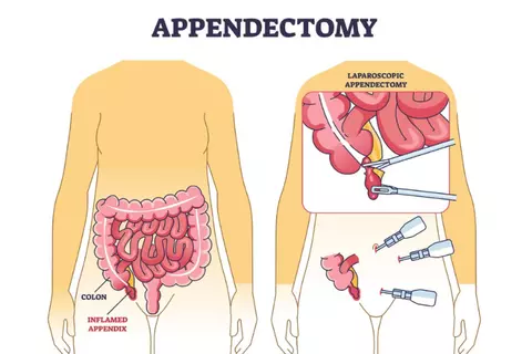 preview_appendicectomy