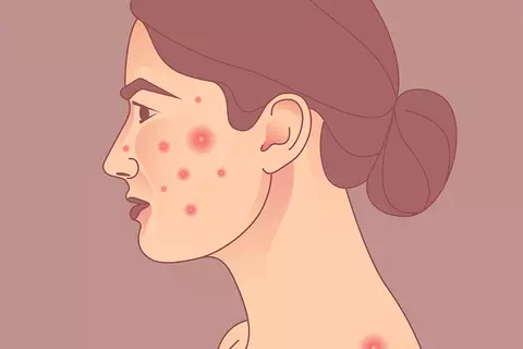 acne_in_nflammatory_bowel_disease