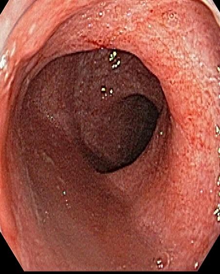 colonoscopia_cuci_afectacion_izquierda