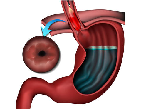 barretts_esophagus
