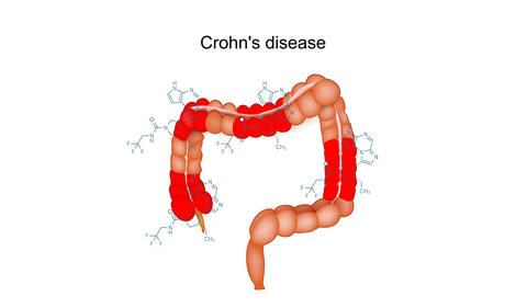 crohns_disease