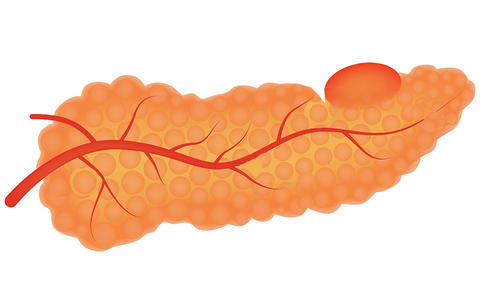 pancreatic_cancer