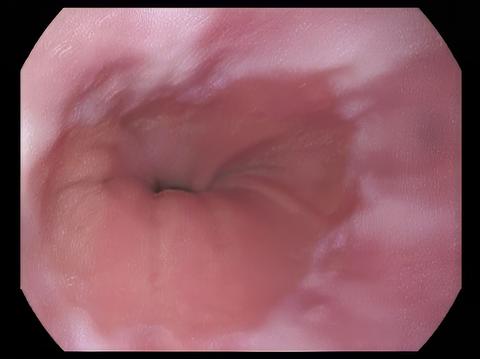 esófago_endoscopía