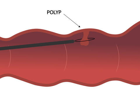 colon-polyp