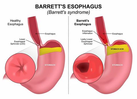 barretts-esophagus